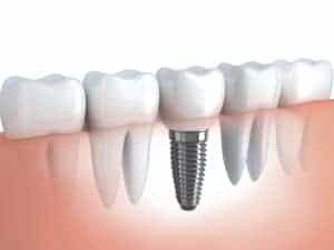 Implantul dentar: 4 lucruri interesante pe care trebuie sa le stii