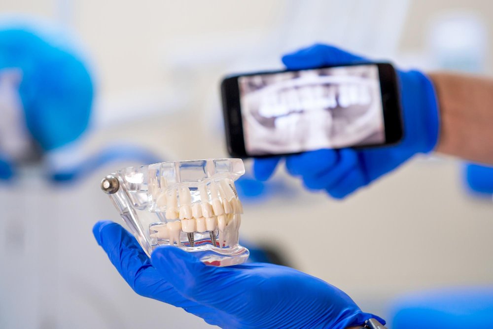 implant dentar