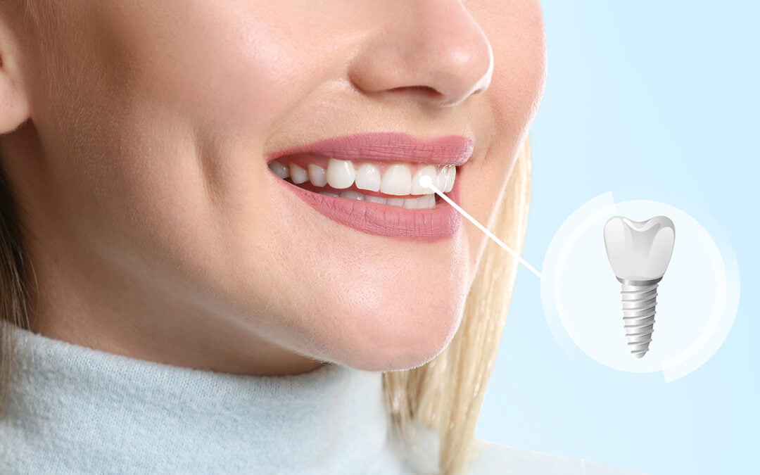 implant dentar