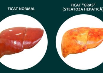 Ficat Normal Vs. Ficat Steatoza Hepatica